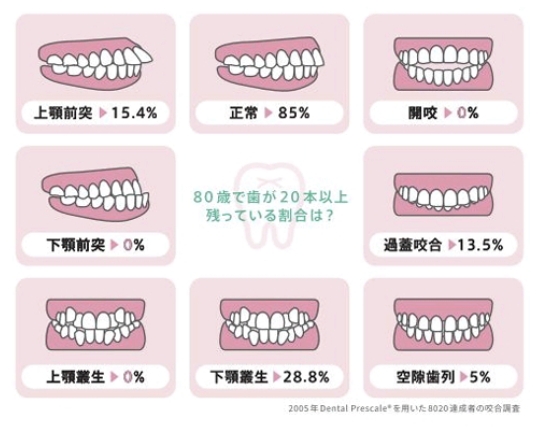 不正咬合と将来の歯の健康に関する説明